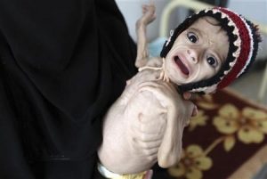 وزير الصحة: آلاف الأطفال يموتون نتيجة سوء التغذية والأمراض القاتلة في اليمن