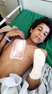 إصابة طفل بانفجار جسم من مخلفات العدوان في مأرب