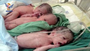 ولادة ثلاثة توائم في مستشفى الكويت الجامعي بالأمانة