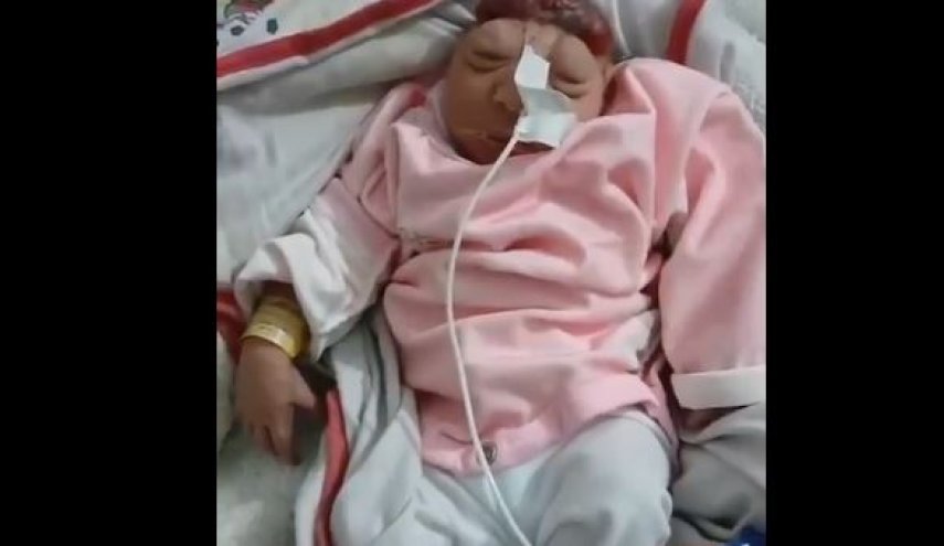 ولادة طفلة “بلا دماغ” في غزة بسبب إشعاعات القصف الصهيوني