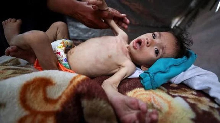 “الأونروا”: 508 أطفال في قطاع غزة مصابون بسوء التغذية الحاد