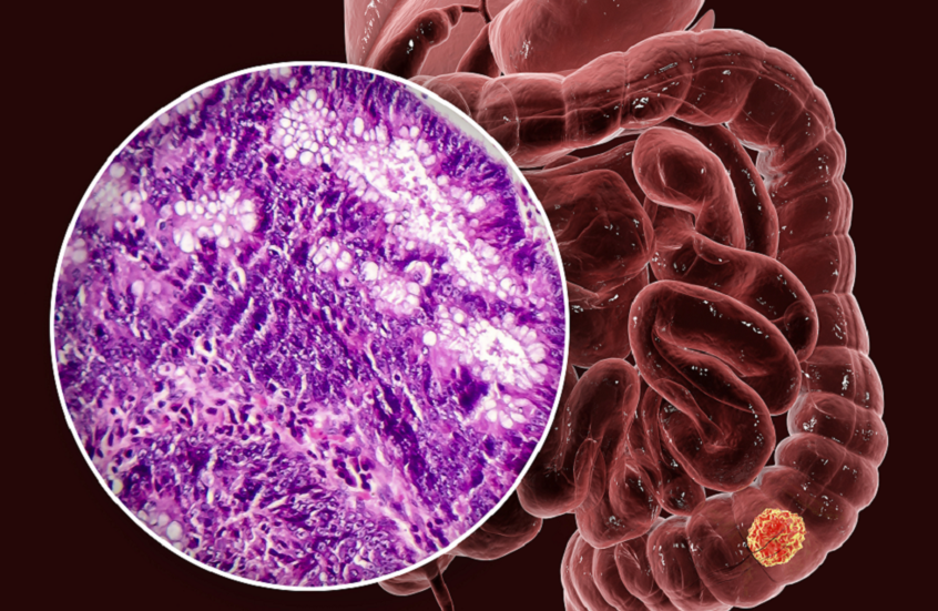 اكتشاف جديد يفتح آفاقا لعلاجات مبكرة لأورام الجهاز الهضمي