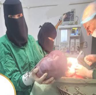 استئصال كيس كبير من مبيض امرأة في مستشفى ذمار