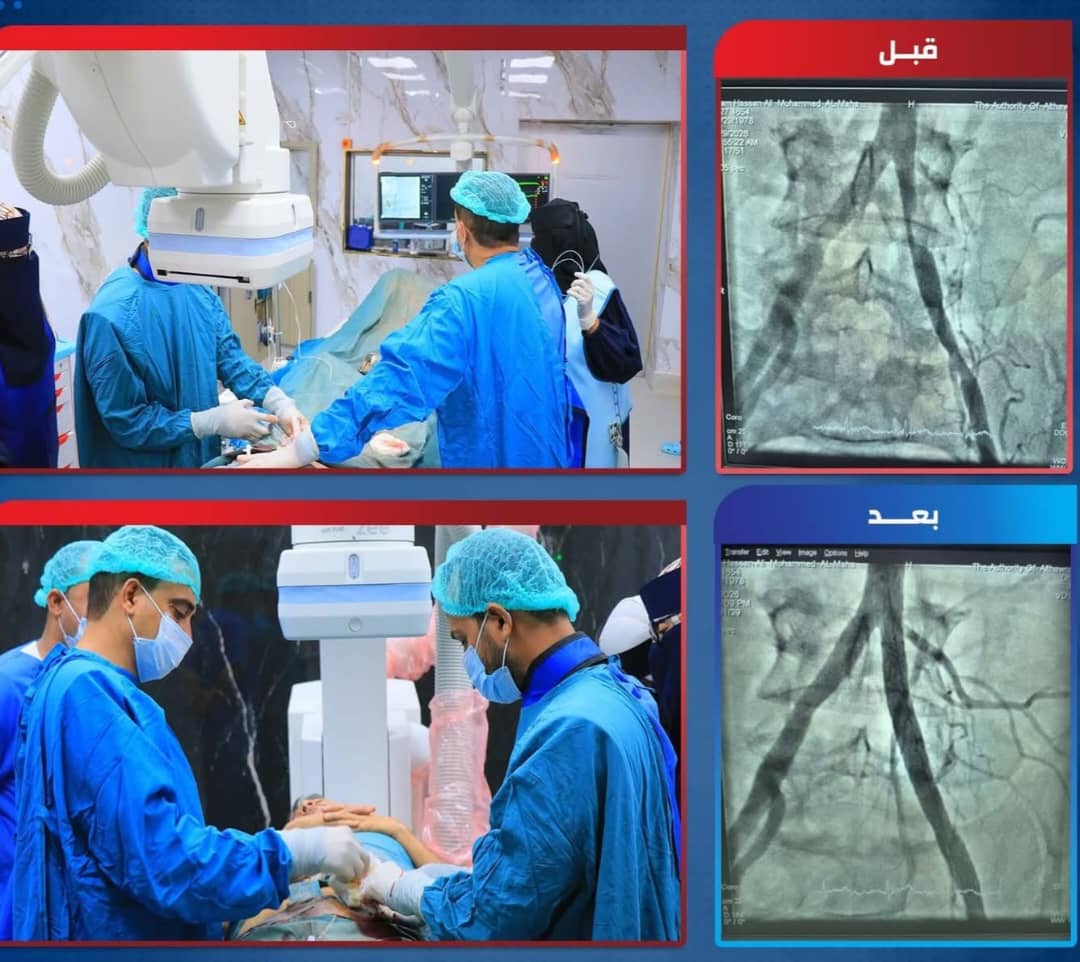 نجاح أول عملية قسطرة طرفية في مستشفى الثورة بالحديدة
