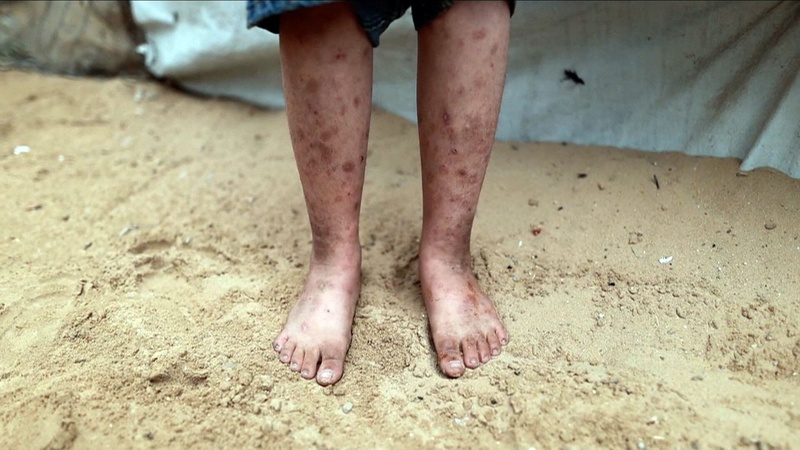 الصحة العالمية: تسجيل 17 ألف إصابة مرتبطة بالقوارض في غزة