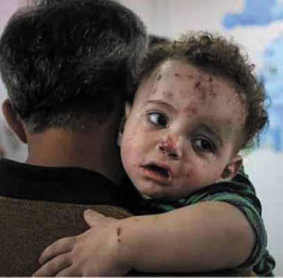 مؤشرات مقلقة وأزمة صحية تتفاقم الجدري ينهش أجساد الأطفال في غزة..